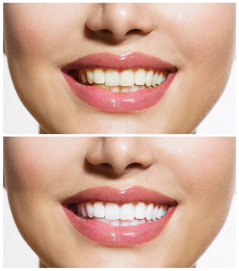 Sapphire™ Teeth Whitening | Dentist in Arlington, WA